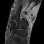 Fig. 3 MRI of the left foot showing involvement of the first metatarsal with cortical destruction
