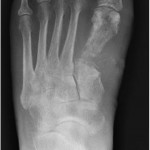 Fig. 5 Radiograph of the left foot after four months of antimicrobial treatment
