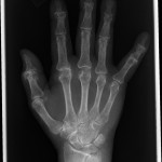 Fig. 2-A A posteroanterior radiograph of the affected hand and wrist demonstrating arthritic changes at the interphalangeal joints as well as joint space narrowing at the metacarpophalangeal joint. 
