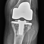 Fig. 1 Anteroposterior radiograph of the left knee at presentation, demonstrating osteolytic destruction of the proximal part of the tibia.
