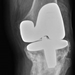 Fig. 4 Anteroposterior radiograph of the left knee, demonstrating varus malunion of the proximal part of the tibia.
