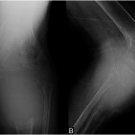 Fig. 1 Anteroposterior (Fig. 1-A) and lateral (Fig. 1-B) radiographs of the knee show extensive destruction of the metaphysis of the proximal part of the tibia with distal extension and a large posterior soft-tissue mass.
