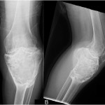 Fig. 3 After twelve months of treatment with denosumab, anteroposterior (Fig. 3-A) and lateral (Fig. 3-B) radiographs of the knee demonstrate reconstitution of the tibial cortices and replacement of the metaphysis with new bone formation.
