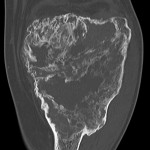 Fig. 4-A After twelve months of treatment with denosumab, a CT scan of the knee (anteroposterior view) demonstrates extensive formation of new bone in the proximal part of the tibia.
