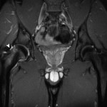 Fig. 1 Pelvic MRI (coronal view) demonstrating bone marrow edema in the right femoral neck (arrowhead).
