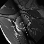 Fig. 2-A A radial T1-weighted image from the MR arthrogram. There is an increased alpha angle of 76°.

