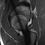 Fig. 2-B A radial T1-weighted image from the MR arthrogram. The nidus (straight arrow) and reactive inflammatory tissue (curved arrow) are evident.
