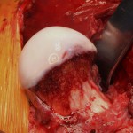 Fig. 4-B Intraoperative appearance of the femoral head after dislocation following resection of the nidus and offset correction.
