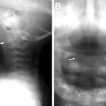 Fig. 1 Lateral (Fig. 1-A) and open-mouth anteroposterior (Fig. 1-B) radiographs at the initial visit. The arrow on each view points to an abnormal calcified mass.
