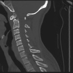 Fig. 1 Initial sagittal CT image demonstrating an os odontoideum.
