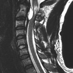 Fig. 2 Sagittal T2-weighted image from the initial preoperative MRI showing a large fluid collection adjacent to the C2 body as well as upper cervical cord edema.
