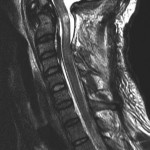 Fig. 4 Midsagittal T2-weighted MRI image after the second decompression, which demonstrates resolution of the synovial cyst as well as residual spinal cord signal change.
