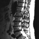 Fig. 1-A T2-weighted MRI of the spine one month prior to the initial operation. Sagittal view demonstrating evidence of a large disc extrusion at L1-L2 (versus disc extrusion with facet hypertrophy) as well as additional disc herniations at L2-L3 and moderate to severe spinal stenosis at L4-L5 with multilevel degenerative disc disease and collapse.
