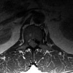 Fig. 1-B T2-weighted MRI of the spine one month prior to the initial operation. Axial view at the level of the L1-L2 disc space demonstrating disc extrusion (versus disc extrusion with facet hypertrophy) causing severe neuroforaminal narrowing of the lateral recess.
