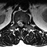 Fig. 2 Preoperative T2-weighted axial MRI of the spine at the level of the L1-L2 disc space demonstrating disc desiccation with symmetrical disc bulging obliterating the left lateral recess and causing impingement of the left traversing nerve. Additionally, there is an epidural rim enhancement presumed to be an extruded free disc fragment. This compression may also have been related to disc extrusion with facet joint hypertrophy.
