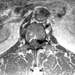 Fig. 3 T2-weighted axial MRI of the spine at the level of the L1-L2 disc space three months after the L1-L2 discectomy, again demonstrating a lobular focus of low signal extending into the foramen impinging on the left exiting L1 nerve, similar to prior imaging studies. This was initially thought to be a new disc extrusion accompanied by a complex synovial cyst containing blood products (versus potential pigmented villonodular synovitis). Further diagnostic testing would reveal this to be an SDAVF at the level of the L1 and L2 vertebrae with multiple feeder vessels.
