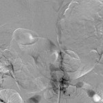 Fig. 4-A Intraoperative angiogram. Left L1 segmental artery injection showing a racemic arteriovenous fistula with an early draining vein going cephalad.
