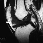 Fig. 1-A Sagittal T1-weighted MRI of the left knee. A mass lesion (arrow) measuring 2 cm in length is anterior to the intercondylar notch, showing low signal intensity.
