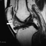 Fig. 1-B Sagittal T2-weighted MRI of the left knee. A mass lesion (arrow) measuring 2 cm in length is anterior to the intercondylar notch, showing a mixture of low and high signal intensity.
