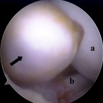 Fig. 2 Intraoperative arthroscopic view. A bucket-handle tear extends from the middle segment to the posterior horn in the lateral meniscus. A large, soft, polyp-like mass with a smooth surface (arrow) is in the central portion of the bucket handle. a = femoral condyle and b = lateral meniscus.
