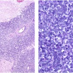 Fig. 2 Low-power (left) and high-power (right) light microscopy (hematoxylin and eosin stain) of the tumor showing sheets of small round blue cells with hyperchromatic nuclei, mitotic figures, and cells with scant cytoplasm.
