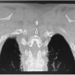 Fig. 1 Coronal CT image of the scapula.
