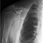 Fig. 10 Anteroposterior radiograph of the right shoulder showing the healing scapular fracture; the arrow indicates callus formation.
