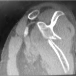 Fig. 3 Sagittal CT image showing the left scapular fracture demonstrating mild rotation of the component anterior to the left scapular body.
