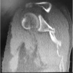Fig. 4 Sagittal CT image showing the right comminuted scapular fracture. 
