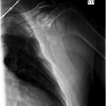 Fig. 5 Scapular-Y radiograph of the left scapular fracture at the four-week follow-up.
