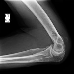 Fig. 7 Radiograph of the left elbow showing calcium deposit proximal to the distal triceps insertion.
