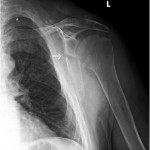 Fig. 9 Anteroposterior radiograph of the left shoulder showing the healing scapular fracture; the arrow indicates callus formation.
