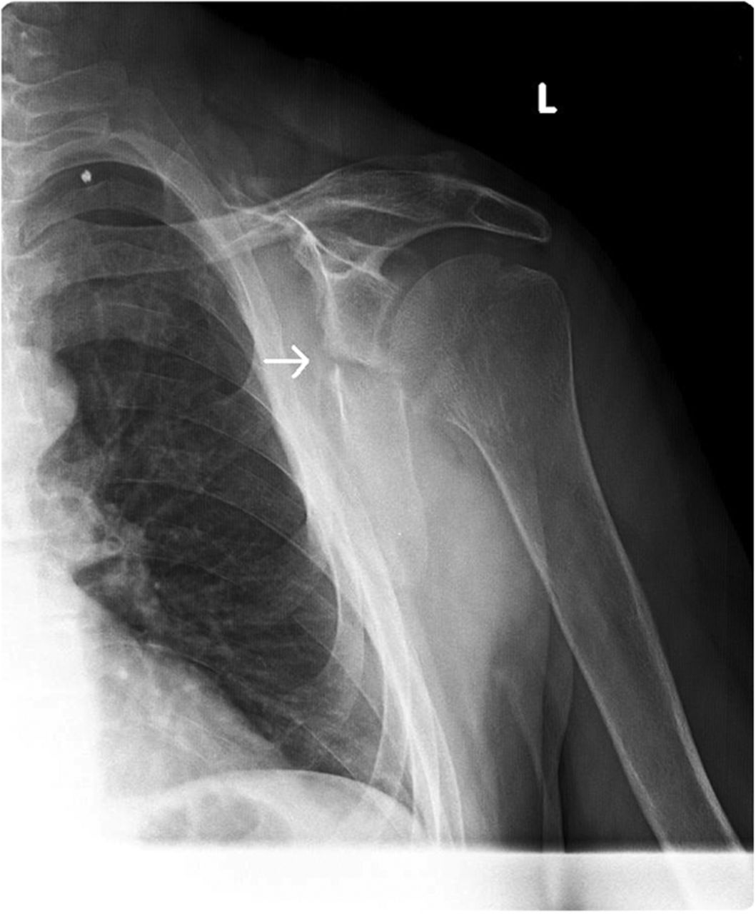 A Forty-two-Year-Old Man with Shoulder Weakness Following a Seizure ...
