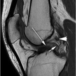 Fig. 1-A Sagittal T1-weighted MRI of the right knee showing the torn ACL (long arrow). Other ligaments are also shown (short arrow, arrowhead). 
