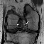 Fig. 1-B Coronal proton density MRI of the right knee showing the torn ACL (long arrow). Also shown is another ligament (short arrow). 
