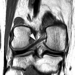 Fig. 1-C Coronal proton density MRI of the right knee showing the torn ACL. Also shown is another ligament (arrowhead). 
