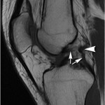 Fig. 2-A Sagittal T1-weighted MRI of the left knee showing a hypoplastic PCL (short arrows). There is a relatively hyperplastic posterior meniscofemoral ligament of Wrisberg (arrowhead). 
