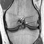 Fig. 2-C Coronal proton density MRI of the left knee showing a hypoplastic PCL (short arrows). There is the intact, normally developed ACL (long arrow).
