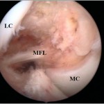 Fig. 3 Arthroscopic image of the meniscofemoral ligament (MFL), the medial femoral condyle (MC), and the lateral femoral condyle (LC).
