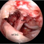 Fig. 4 Arthroscopic image of the meniscofemoral ligament (MFL) and the ACL graft (ACLG).
