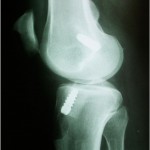 Fig. 5-B Postoperative lateral radiograph showing that there were no signs of hypoplastic tibial eminences; the correct position of the interference screws is also evident.

