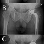 Fig. 1 Anteroposterior pelvic radiographs made at the time of the initial presentation to the clinic, at which time substantial bilateral acetabular degeneration and joint-space narrowing were noted, with destruction of the left femoral head and proximal migration of the left femur (Fig. 1-A); after placement of the PROSTALAC spacer (Fig. 1-B); and three months after the definitive total hip arthroplasty (Fig. 1-C).
