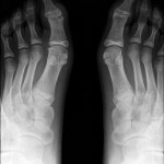 Fig. 1 Preoperative radiograph, revealing bilateral subchondral hyperlucent lesions on the distal articular surface of the first phalanx of each hallux, with detachment on the left side.
