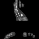 Fig. 2 Preoperative CT scan, showing in detail the lesion located in the left hallux.
