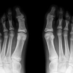 Fig. 3 One-year follow-up radiograph after stabilization of the left capsule, already revealing detachment of the right lesion in the same way that it was seen before on the left lesion. However, the patient reported no symptoms on this foot whatsoever, despite it being his dominant one.
