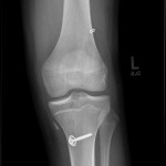 Fig. 1 The radiograph shows the ACLR with a hamstring autograft.

