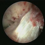 Fig. 2 Arthroscopic debridement showing the intact ACL graft.

