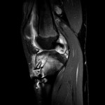 Fig. 3 MRI five months postsurgery demonstrated synovitis, an intact but attenuated graft, and increased signal in the proximal part of the tibia near the area of the screw, as well as an associated fluid collection.
