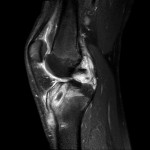 Fig. 4 MRI six weeks after the second debridement demonstrated continued increased signal in the proximal part of the tibia around the tibial tunnel.

