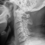 Fig. 1 Lateral radiograph of the cervical spine, made at the time of presentation, demonstrating focal kyphosis at C5-C6.
